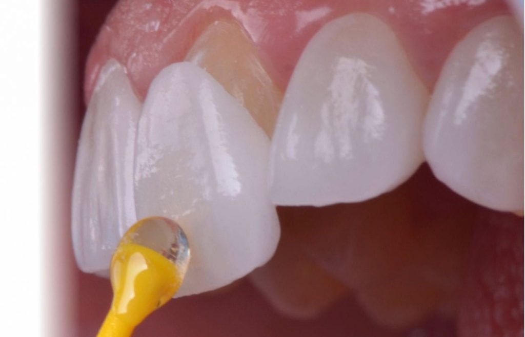 What is laminate teeth?