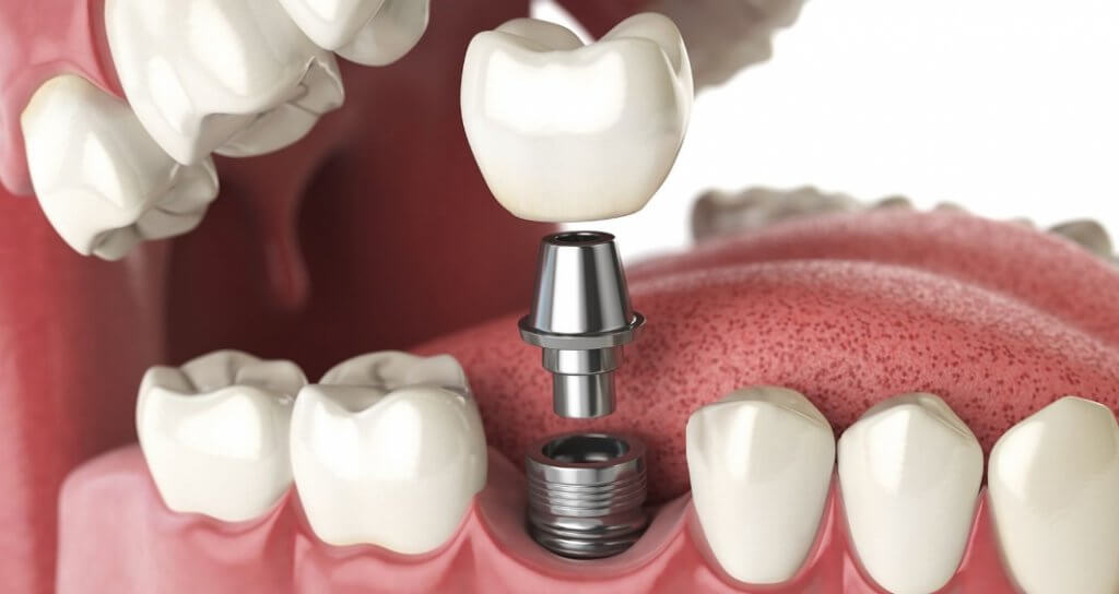 Dental implant nedir?